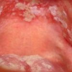 Inflammation on the palate