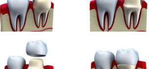 Restoration of the tooth crown