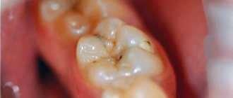 Восстановление жевательных и боковых зубов