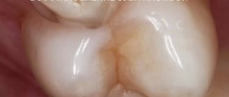 Restoring a tooth with a filling. Tooth restoration 