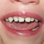 Ulcers on a child&#39;s tongue