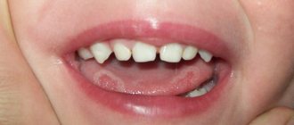 Ulcers on a child&#39;s tongue
