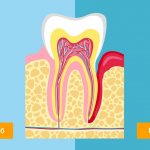 Healthy tooth and periodontitis in pictures