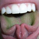Green coating on the tongue
