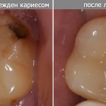 wisdom tooth before and after treatment