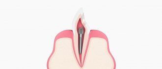 Tooth reinforced with a pin in pictures