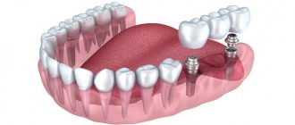 Dental bridge on implants