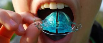 Are dental plates better than braces for children? – orthodontist Elena Ryaguzova, Moscow 