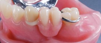 Dentures made of acrylic plastic. Advantages and disadvantages 